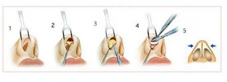 微調(diào)鼻子需要多少錢，全面解析費用因素與注意事項，微調(diào)鼻子費用全解析，費用因素與注意事項，需要多少錢？
