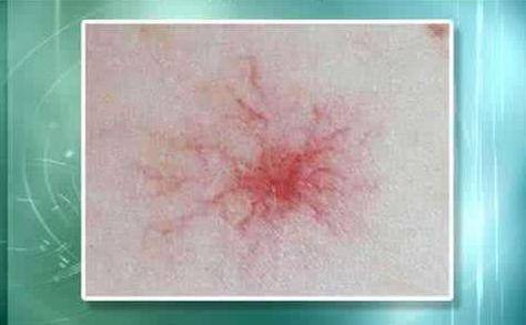 肝癌身上出現(xiàn)紅點圖片，癥狀解析與關注，肝癌身上紅點解析，癥狀、圖片及關注重點