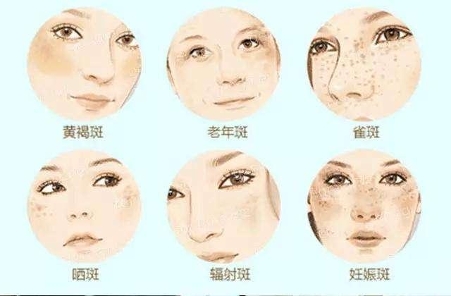 黃褐斑早期圖片，識別、預防與應對，黃褐斑早期識別、預防與應對策略及圖片解析