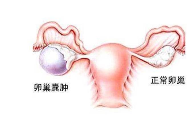 卵巢囊腫的癥狀及應(yīng)對(duì)方法，卵巢囊腫的癥狀與應(yīng)對(duì)之策