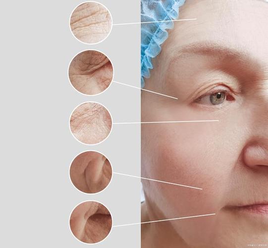 激光去皺紋，效果維持時(shí)間與多重因素解析，激光去皺紋，效果維持時(shí)間與多重因素詳解