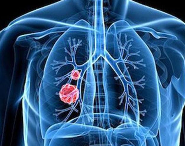 肺部感染恢復(fù)時間解析，多久能夠康復(fù)？，肺部感染恢復(fù)時間解析，多久可康復(fù)？