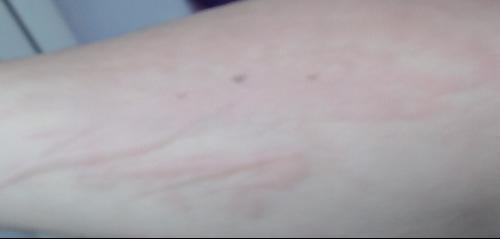 急性過敏性蕁麻疹，全面解析與應(yīng)對(duì)策略，急性過敏性蕁麻疹，全面解析及應(yīng)對(duì)指南