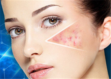 激光祛痘印大概需要多少錢呢？全面解析費用因素與注意事項，激光祛痘印費用全解析，費用因素與注意事項，了解需要多少錢！