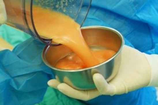 雙下巴抽脂手術(shù)費(fèi)用詳解，價(jià)格因素與預(yù)算參考，雙下巴抽脂手術(shù)費(fèi)用解析，預(yù)算參考與價(jià)格因素探討