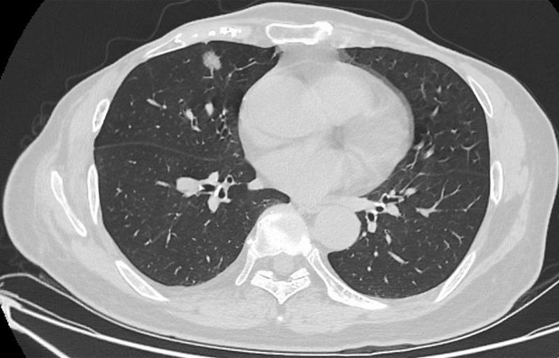 肺結(jié)節(jié)最佳治療方法，全面解析與你的健康之路，肺結(jié)節(jié)最佳治療方法詳解，為您的健康之路指引方向