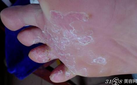 腳脫皮怎么辦？藥物治療推薦與護理建議，腳脫皮解決方法，藥物治療推薦及護理建議