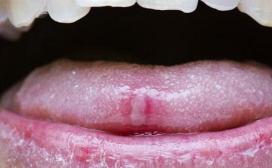 口腔粘膜炎癥，深入了解與治療策略，口腔粘膜炎癥，全面解析與治療指南