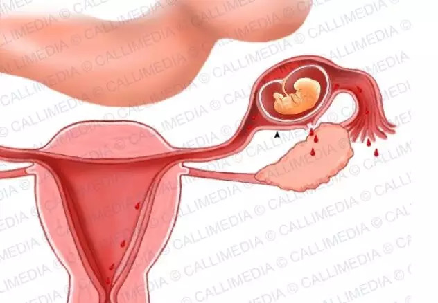 宮外孕20天最明顯的征兆，宮外孕20天的明顯征兆，早期識(shí)別與應(yīng)對(duì)的關(guān)鍵時(shí)刻