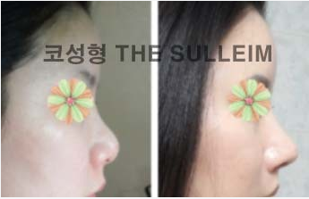 如何縮小鼻翼不手術(shù)，實(shí)用方法與建議，不手術(shù)縮小鼻翼的實(shí)用方法與建議