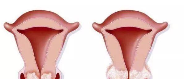 女性HPV初期感染的圖片及其相關(guān)知識(shí)科普，女性HPV初期感染圖片與知識(shí)科普，了解、預(yù)防與治療