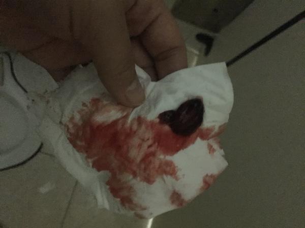 自然流產后的清宮問題解析——自己流掉了需要清宮嗎？，自然流產后需清宮嗎？——深度解析清宮問題疑慮！