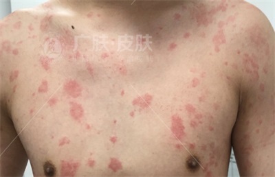 晚上發(fā)作的蕁麻疹名稱及其相關知識解析，夜間蕁麻疹發(fā)作解析，癥狀、原因與知識科普