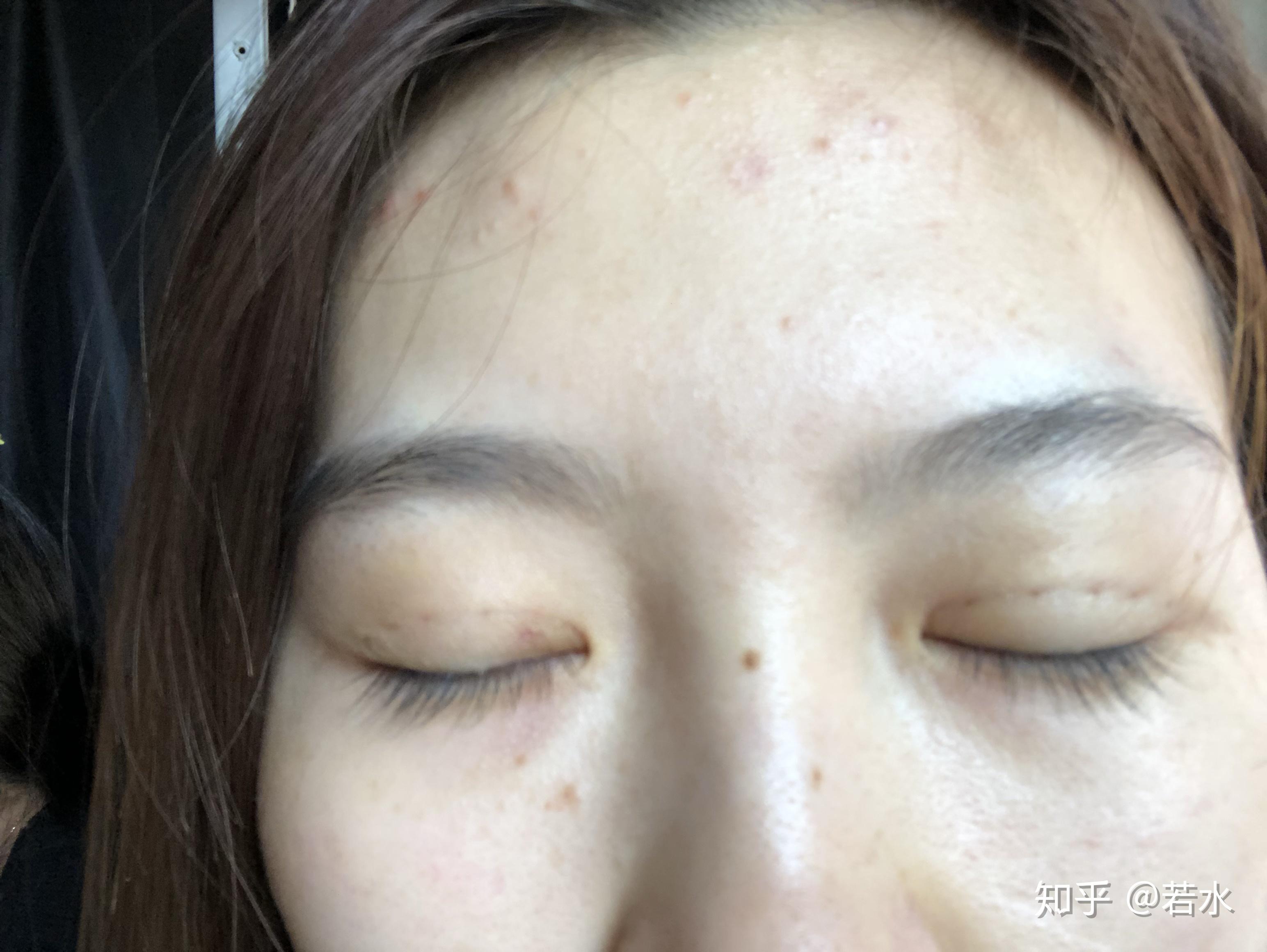 雙眼皮埋線手術(shù)效果持久性解析，持續(xù)時間與影響因素探討，雙眼皮埋線手術(shù)的持久性與影響因素深度解析