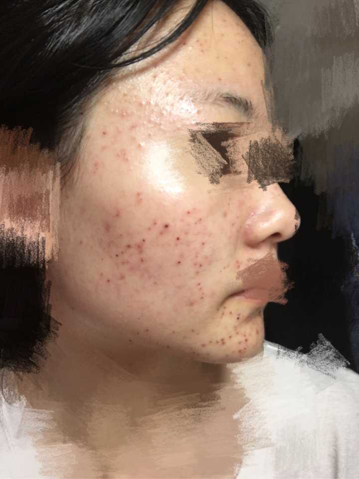 激光祛痘痘有效果嗎，深度解析與全面理解，激光祛痘效果深度解析與全面理解指南