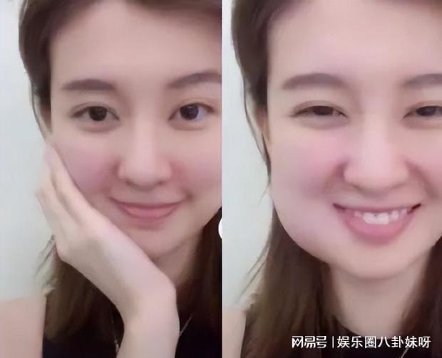 智齒被肉包住了一定要拔嗎？解讀智齒包埋現(xiàn)象及其處理方式，解讀智齒包埋現(xiàn)象，智齒被肉包住是否需要拔除？