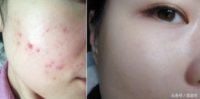 如何祛痘最快最有效的方法，全面解析痘痘成因與解決方案，揭秘最快最有效的祛痘方法，全面解析痘痘成因與解決方案！
