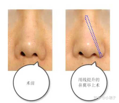 縮小鼻翼的方法，有效改善鼻翼過(guò)大的實(shí)用指南，縮小鼻翼的有效方法，實(shí)用指南助你改善鼻翼過(guò)大問(wèn)題