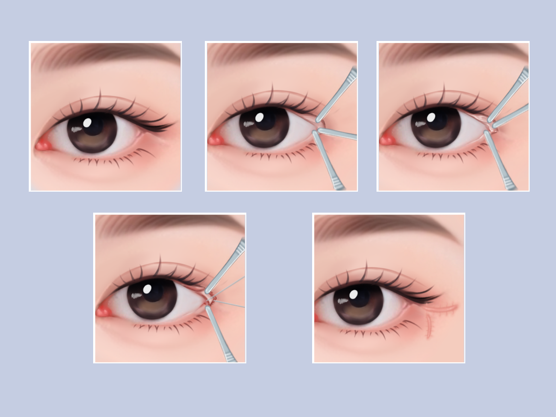 如何讓眼睛變大——全方位指南，全方位指南，讓眼睛變大的秘訣與方法