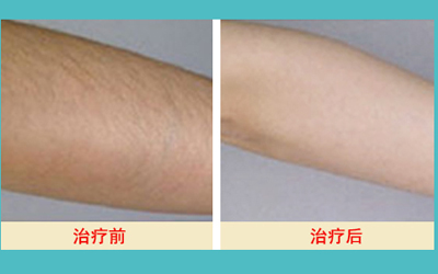 激光脫毛的價格解析，多少錢才能擁有絲滑肌膚？，激光脫毛價格詳解，多少錢能擁有絲滑肌膚？