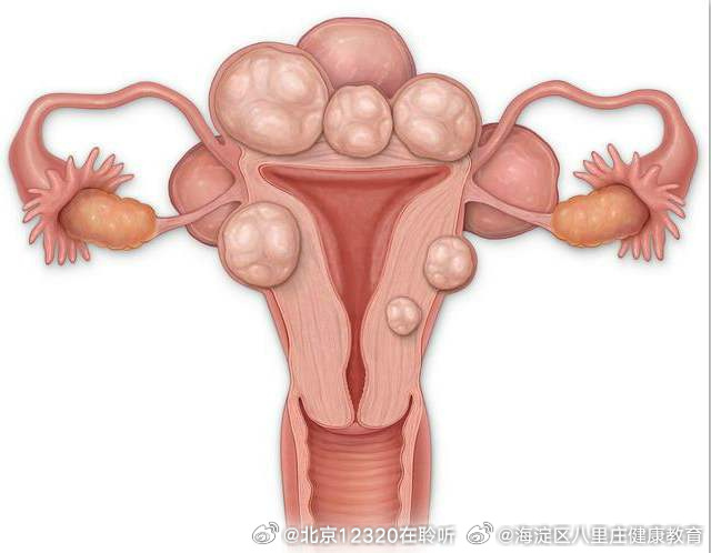 子宮肌瘤的最佳治療方法，全面解析與指導(dǎo)，子宮肌瘤的最佳治療方法詳解與指導(dǎo)手冊