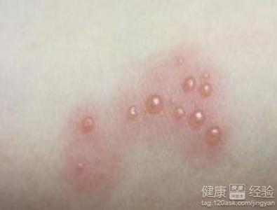 疥瘡的最佳治療方法，全面解析與有效應(yīng)對，疥瘡最佳治療方法解析與應(yīng)對攻略